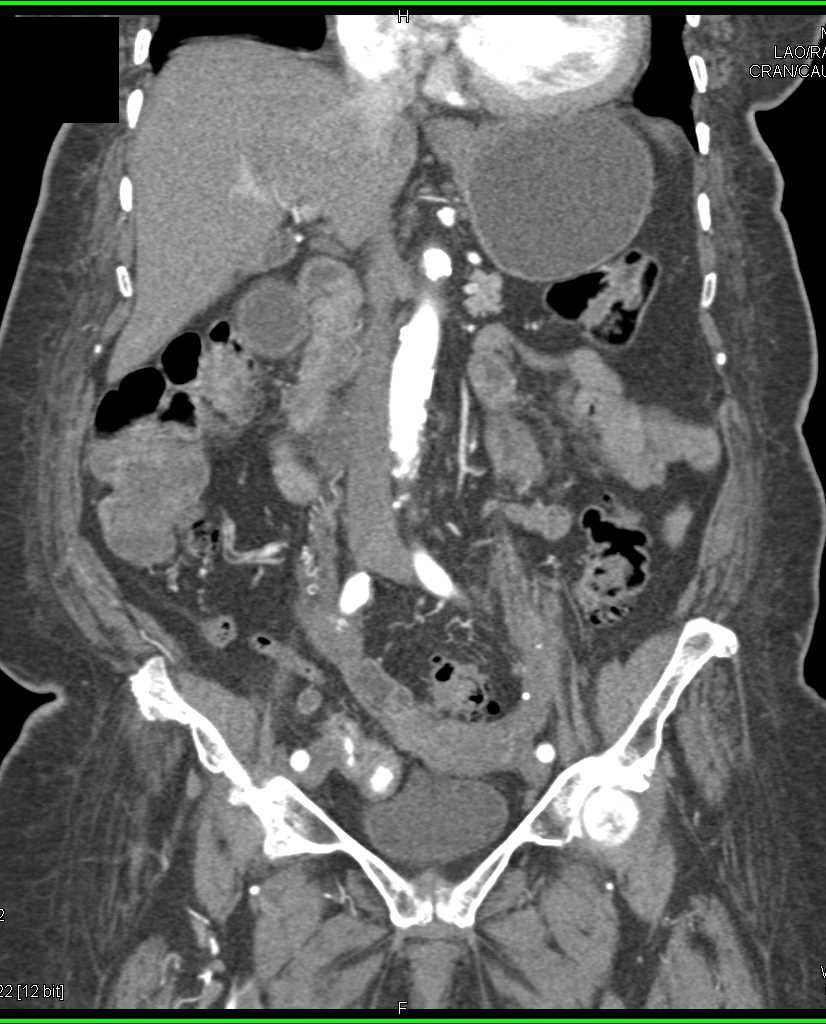 Gastrointestinal (GI) Bleed in the Terminal Ileum - CTisus CT Scan