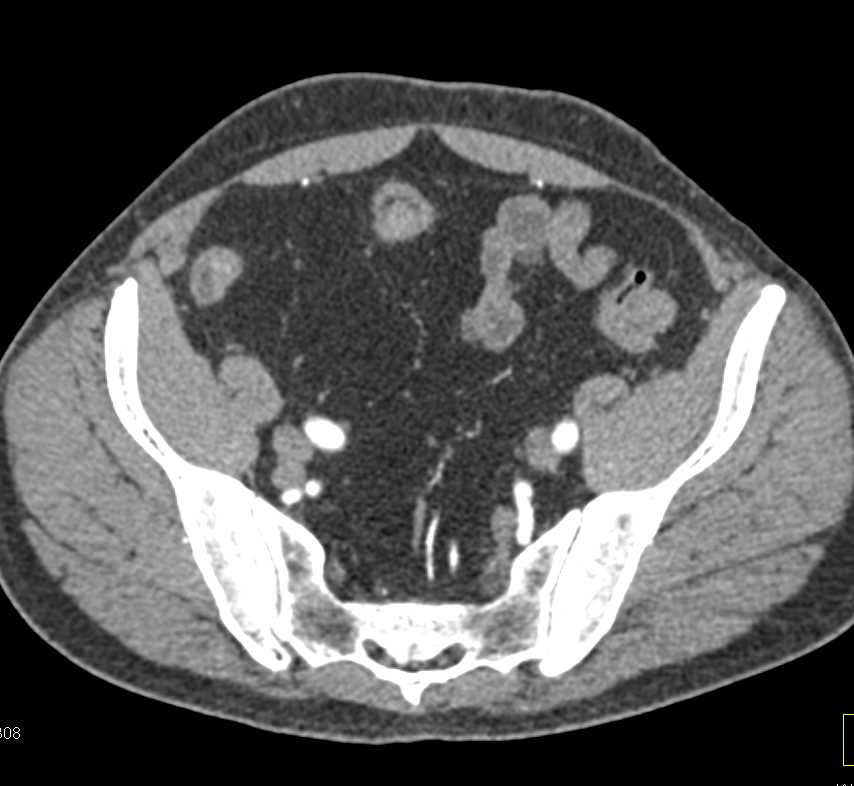 Crohn's Disease Colon and Terminal Ileum - CTisus CT Scan