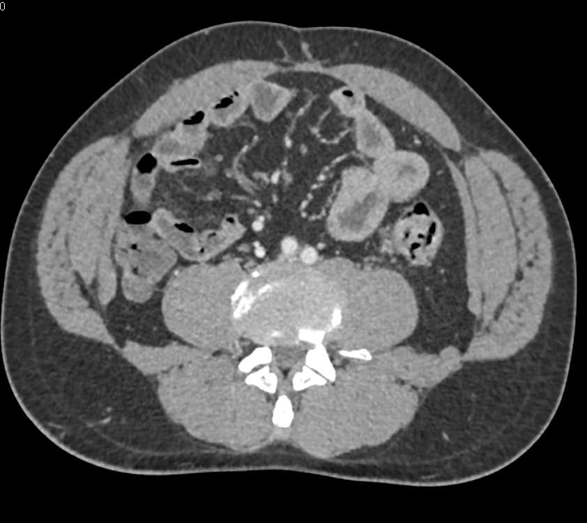 Thickening of Proximal Duodenum due to Edema - CTisus CT Scan