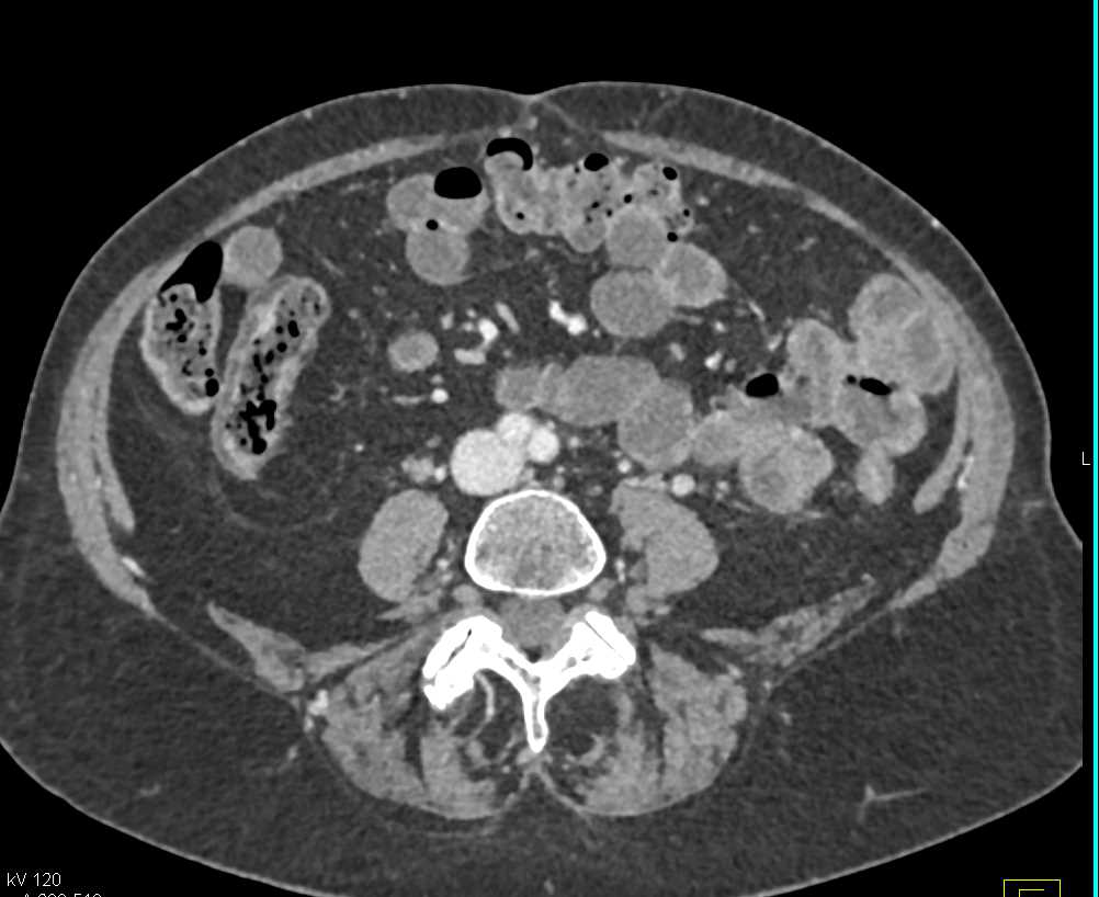 Crohn's Disease Ileum with Comb Sign - CTisus CT Scan