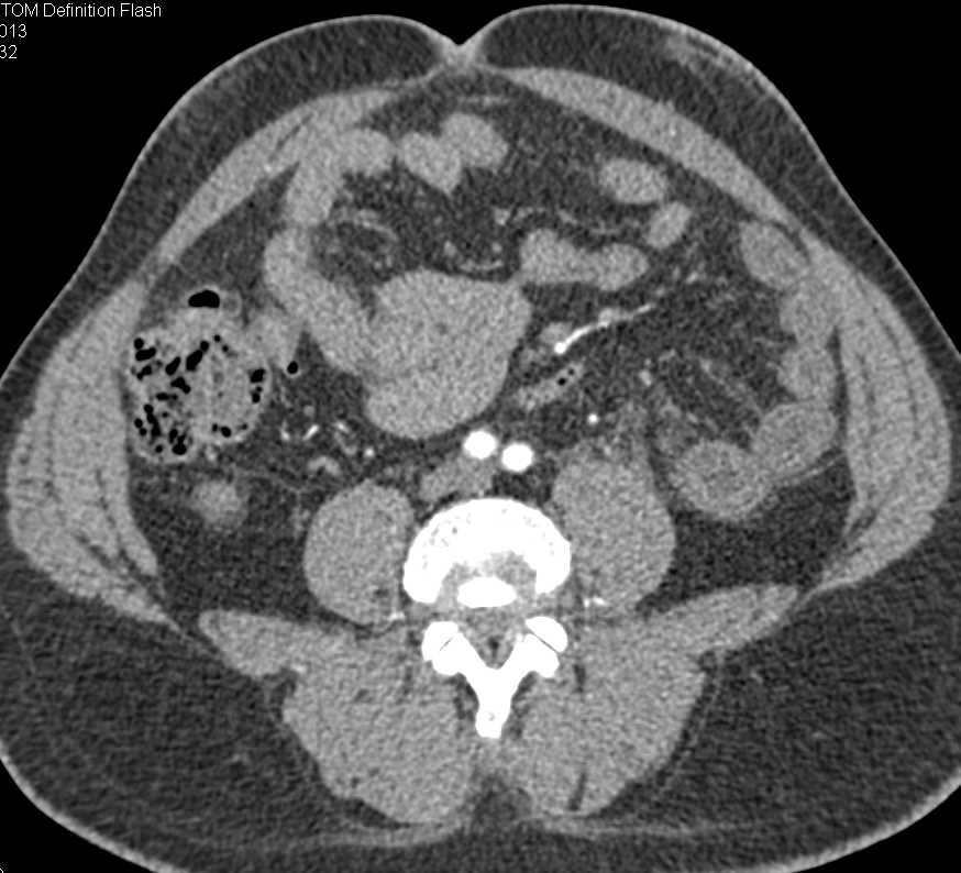 Thickening Small Bowel Loops with Halo due to Crohn's Disease - CTisus CT Scan