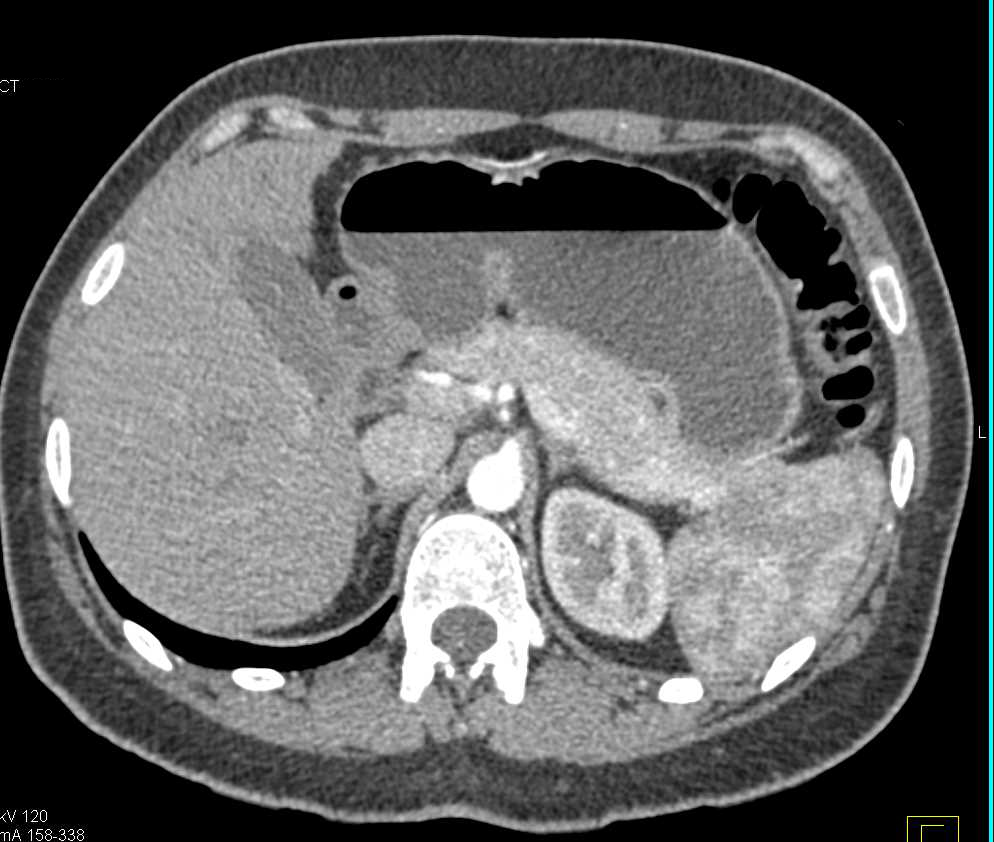 Duodenal Carcinoma Simulates a Pancreatic Head Tumor - CTisus CT Scan