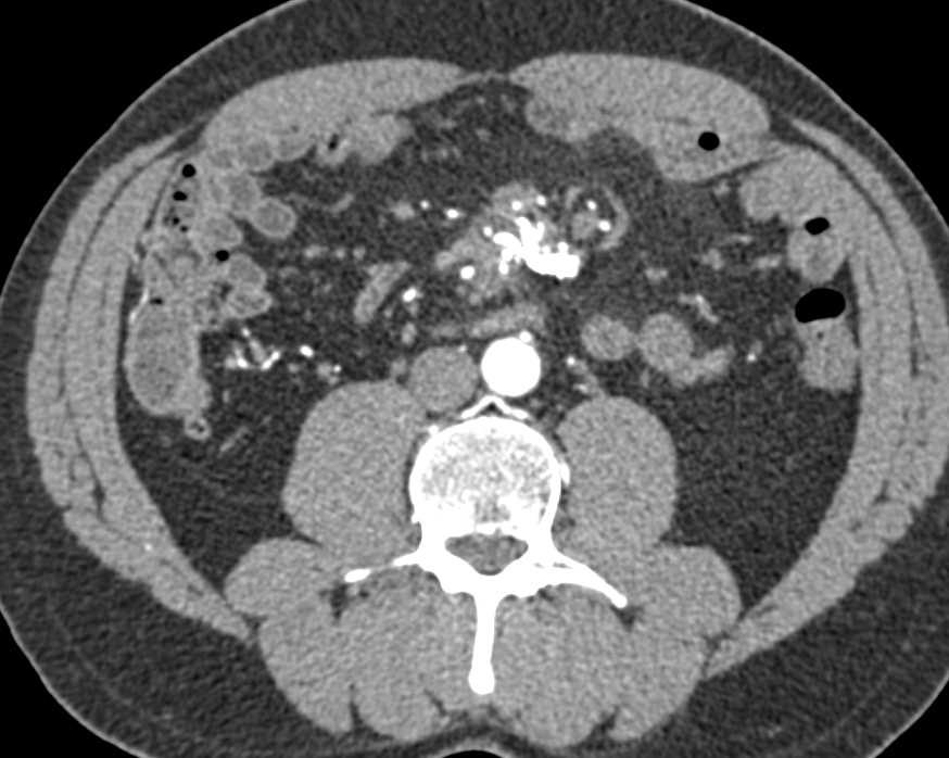 Carcinoid Tumor in the Root of the Mesentery with Calcification - CTisus CT Scan