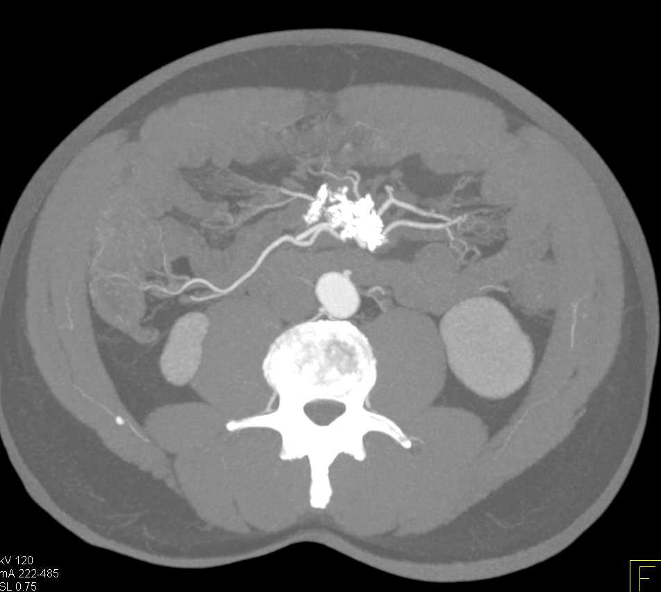 Sclerosing Mesenteritis in Root of Mesentery - CTisus CT Scan