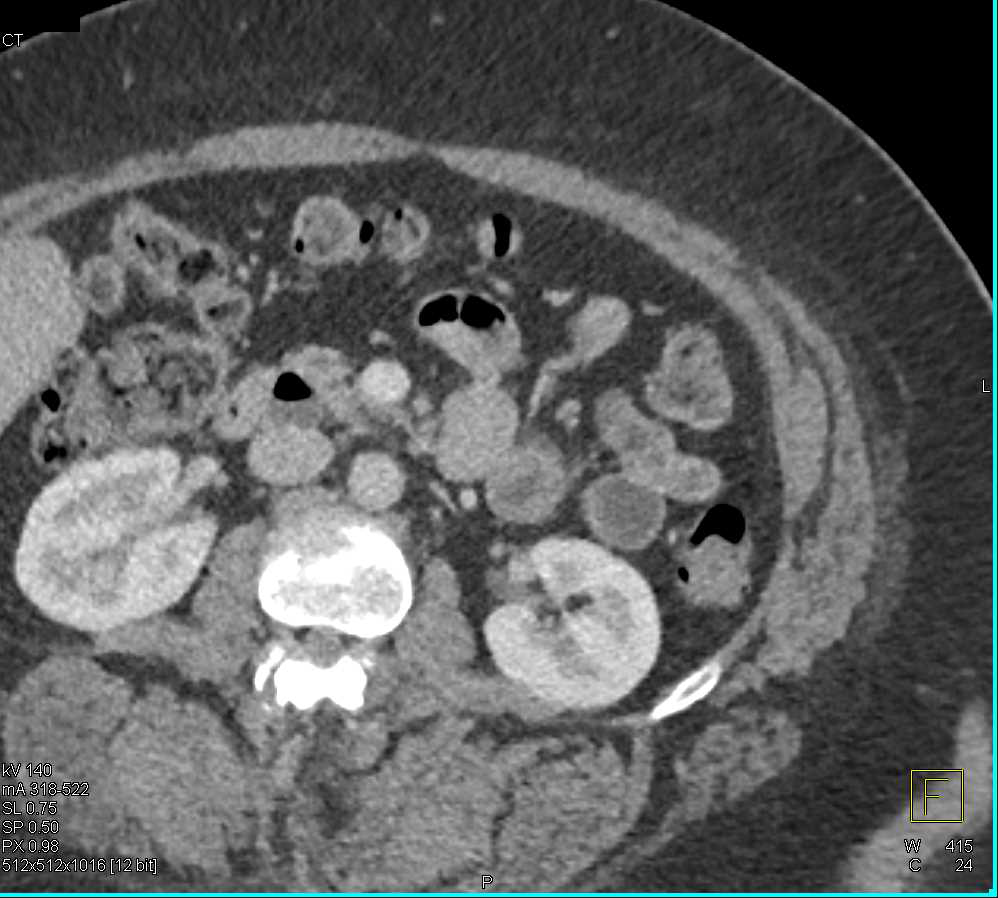 Duodenal Diverticulum - CTisus CT Scan