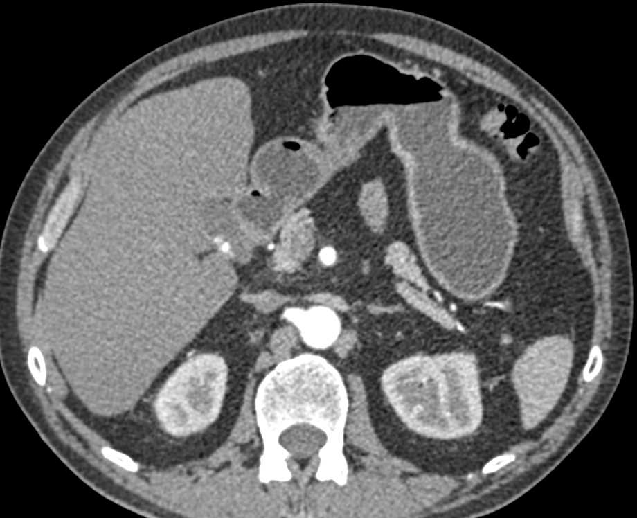 Subtle Duodenal Carcinoma - CTisus CT Scan