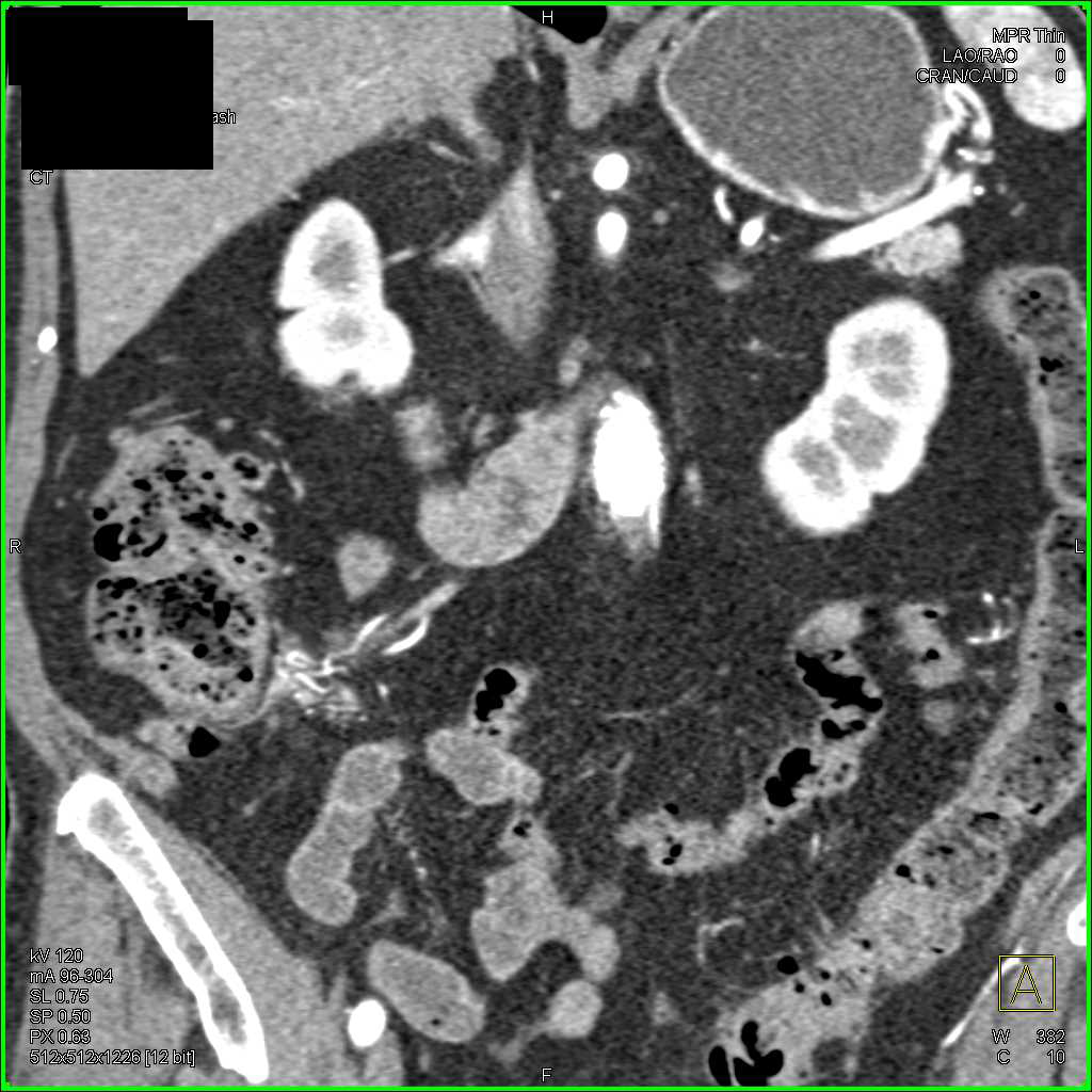 Carcinoid Tumor Near Terminal Ileum - CTisus CT Scan