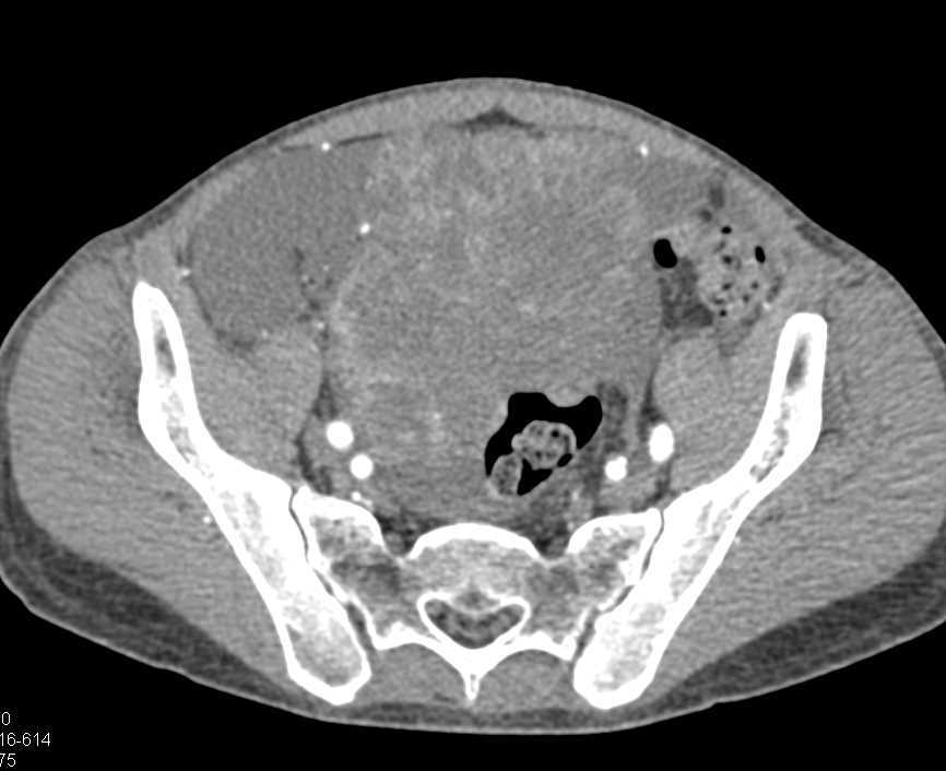 Small Bowel GIST Tumor and Ascites - CTisus CT Scan