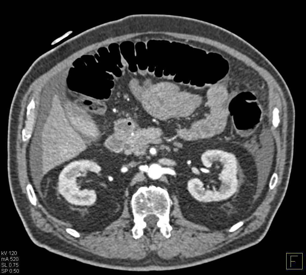 Carcinoid Tumor in the Root of the Mesentery with Calcification and Encases Superior Mesenteric Artery (SMA) and Superior Mesenteric Vein (SMV) - CTisus CT Scan