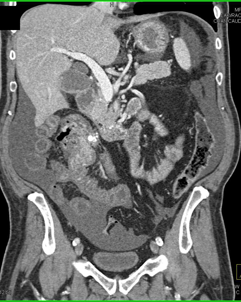 Carcinoid Tumor Near Root of the Mesentery with Desmoplastic Reaction - CTisus CT Scan