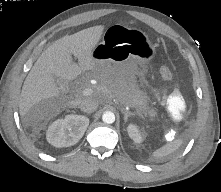 Small Bowel Obstruction due to Pancreatitis - CTisus CT Scan