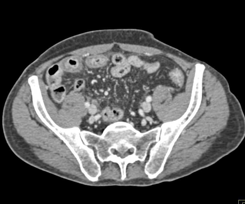 Graft vs Host Disease in the Distal Small Bowel - CTisus CT Scan