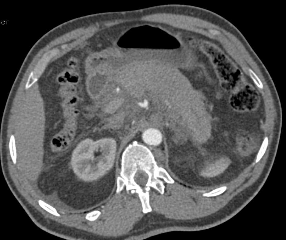 Lymphoma with Infiltration of the Mesentery and the Pancreas - CTisus CT Scan