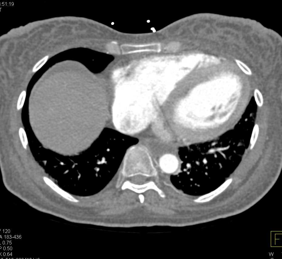 Pneumatosis with Ischemic Bowel due to Superior Mesenteric Artery (SMA) Occlusion - CTisus CT Scan