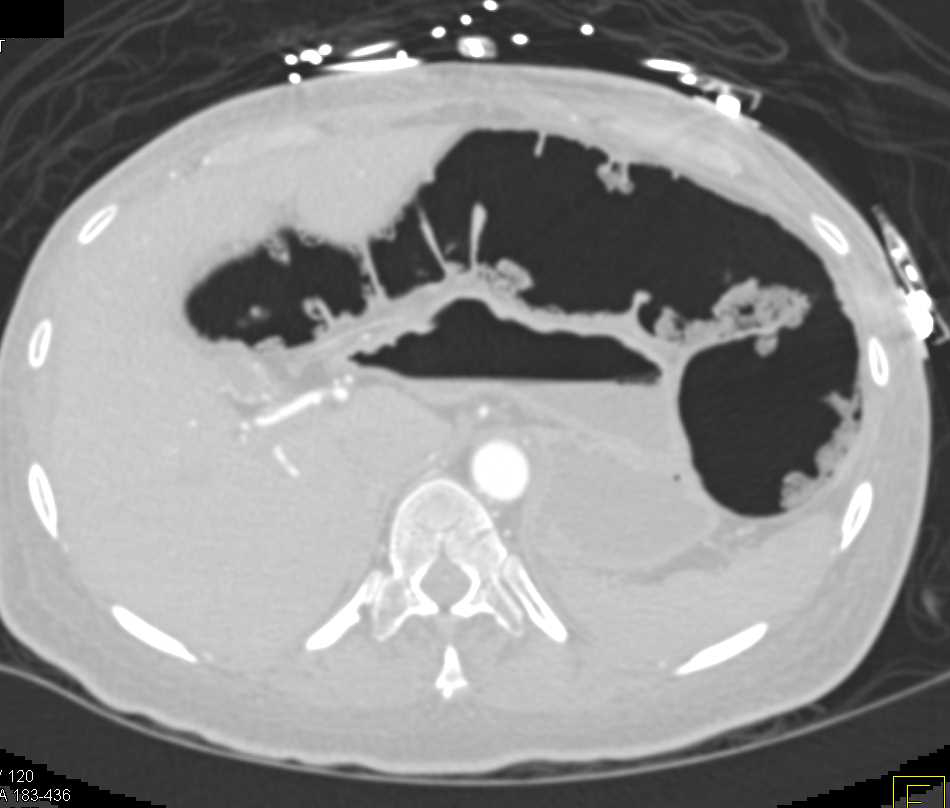 Pneumatosis with Ischemic Bowel due to Superior Mesenteric Artery (SMA) Occlusion - CTisus CT Scan