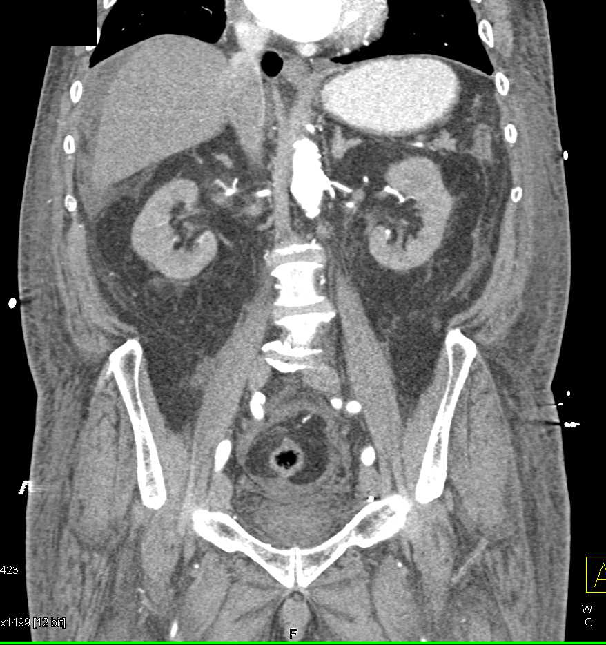 Sprue with Thickened Duodenal Folds and Ascites - CTisus CT Scan