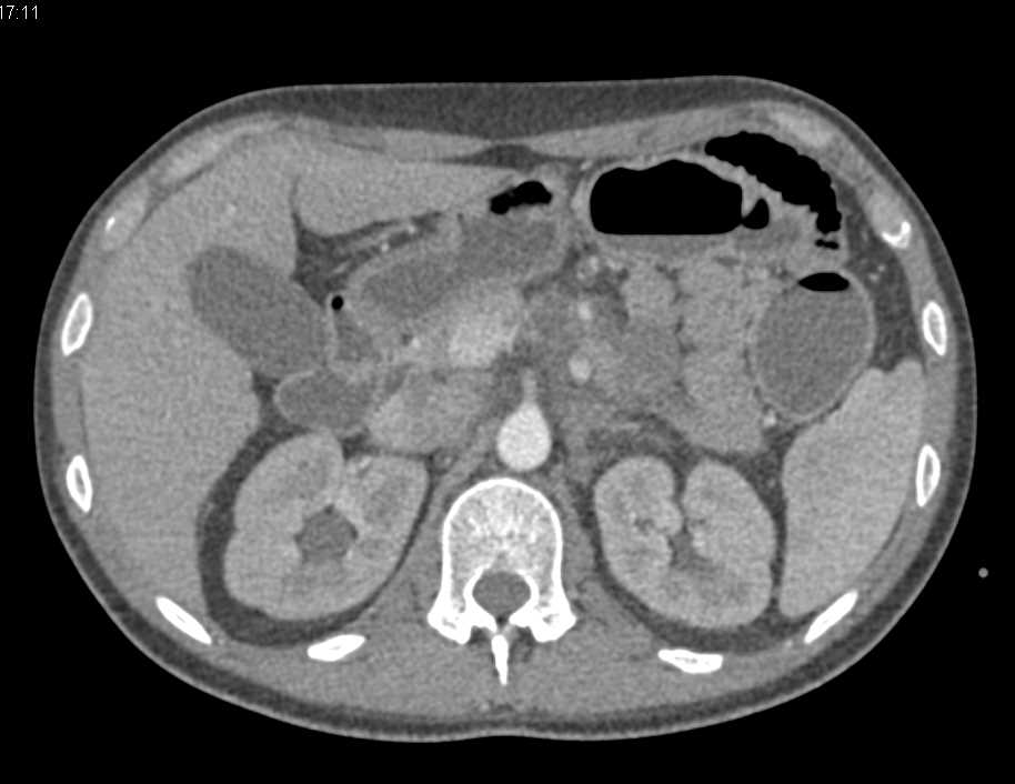 Tumor Infiltration into the Mesentery - CTisus CT Scan