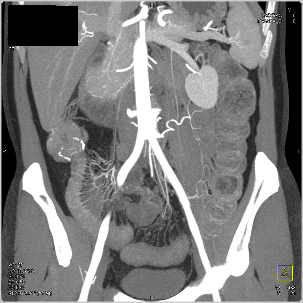 Crohn's Disease Colon and Terminal Ileum with Prior Surgery - CTisus CT Scan