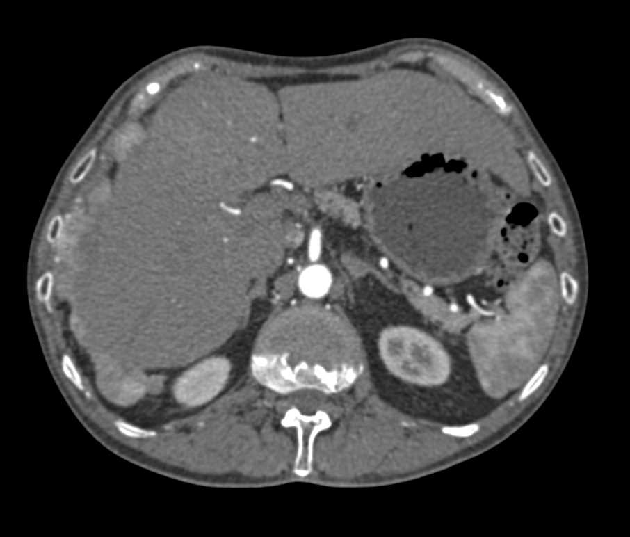 Carcinoid Tumor with Implants Including on the Liver - CTisus CT Scan