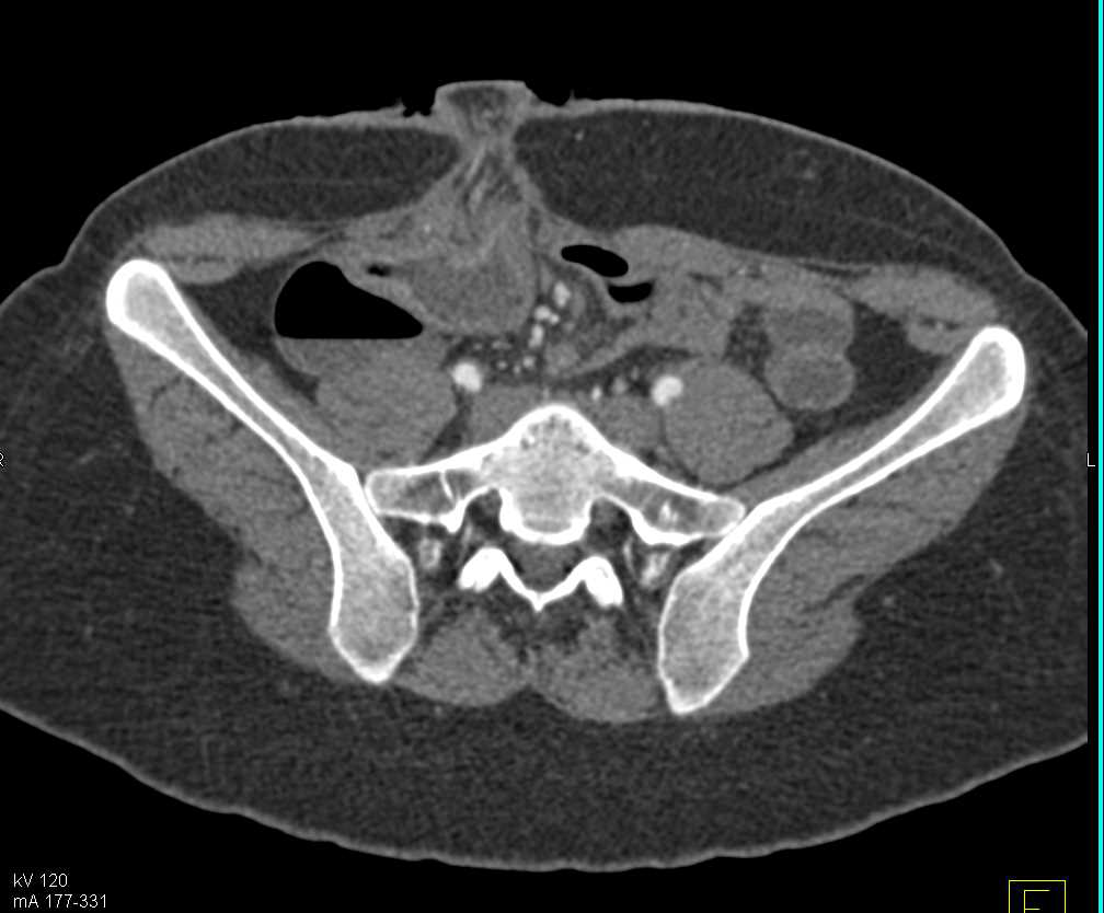 Crohn's Disease with Feces Sign and Diseased Small Bowel - CTisus CT Scan