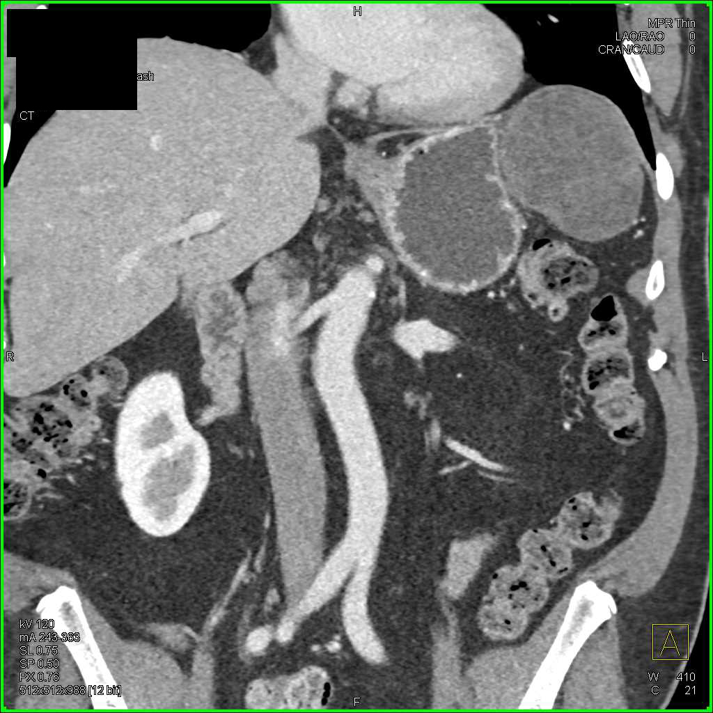 Omental Infarct Left Upper Quadrant Following Distal Pancreatectomy and Splenectomy - CTisus CT Scan