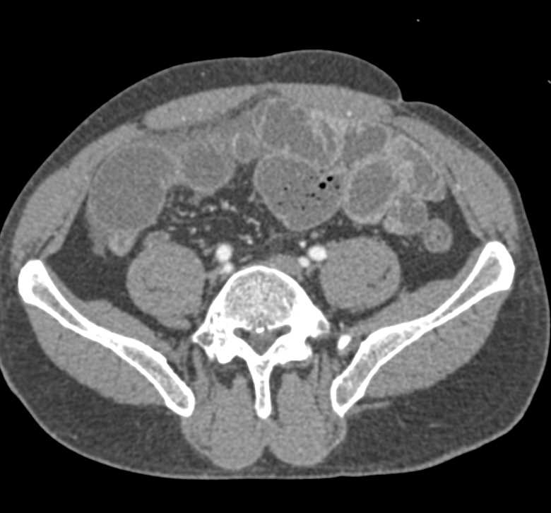 Small Bowel Obstruction due to Adehesions - CTisus CT Scan