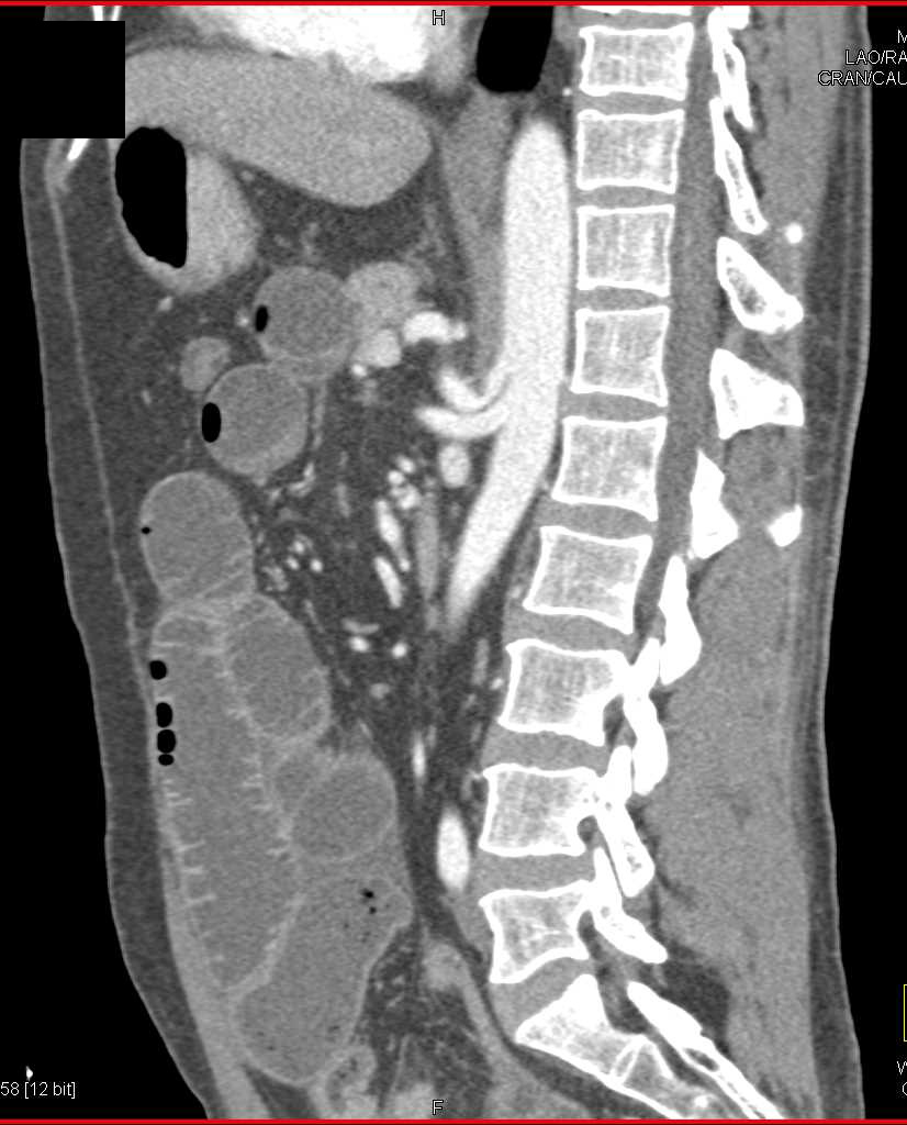 Small Bowel Obstruction due to Adehesions - CTisus CT Scan