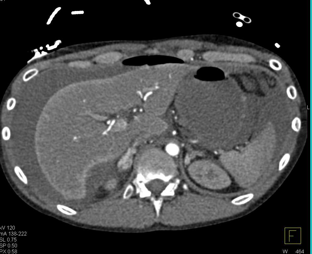 Pneumoperitoneum due to Bowel Perforation - CTisus CT Scan