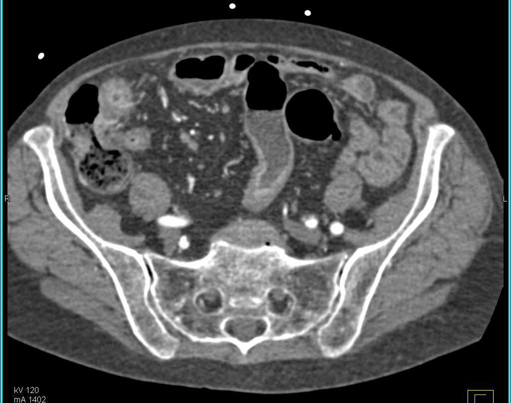 Crohn's Disease with Thickened Small Bowel - CTisus CT Scan