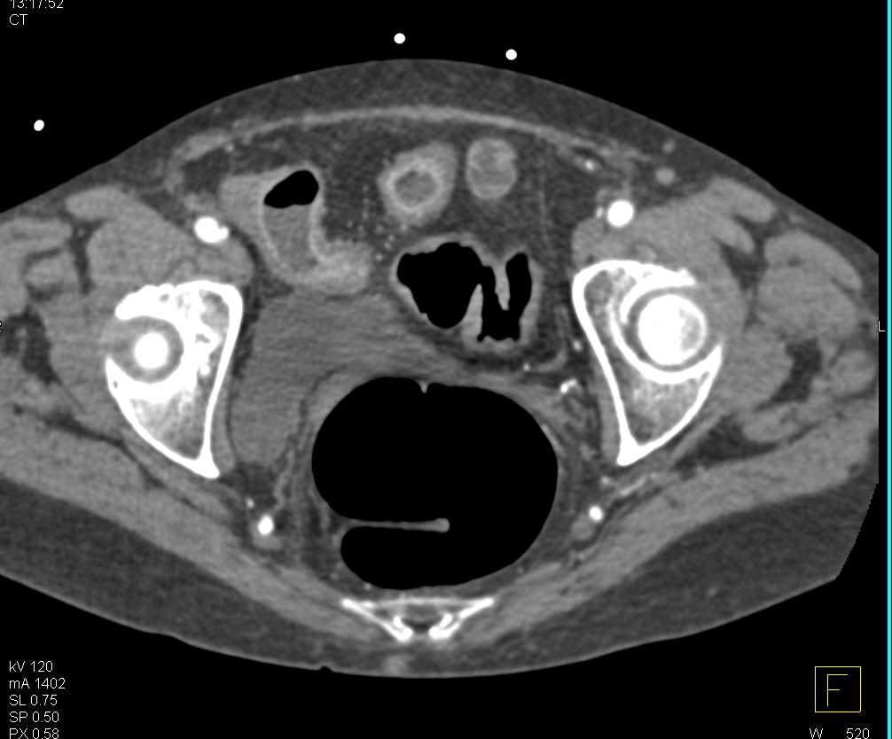 Crohn's Disease with Thickened Small Bowel - CTisus CT Scan