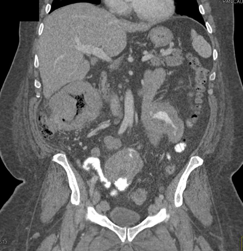 Small Bowel Lymphoma and Adenopathy - CTisus CT Scan