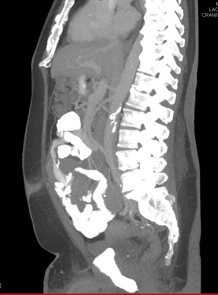 Small Bowel Lymphoma and Adenopathy - CTisus CT Scan