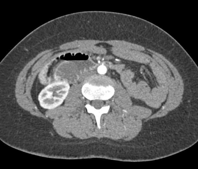 Distal Small Bowel Obstruction with Adhesions and Feces Sign - CTisus CT Scan