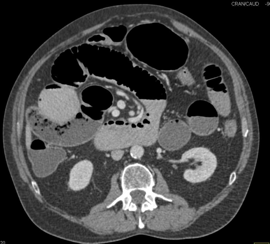 Small Bowel Obstruction due to Adhesions - CTisus CT Scan