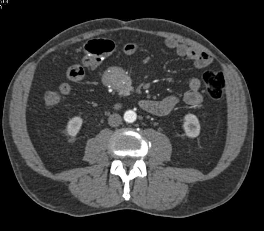 Carcinoid Tumor Root of Mesentery and Liver Metastases - CTisus CT Scan