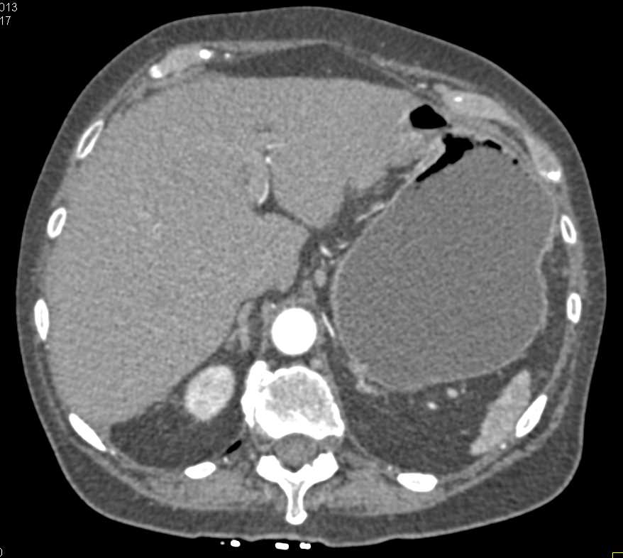 Colon Cancer with Implants in Pelvis Obstructing the Small Bowel - CTisus CT Scan