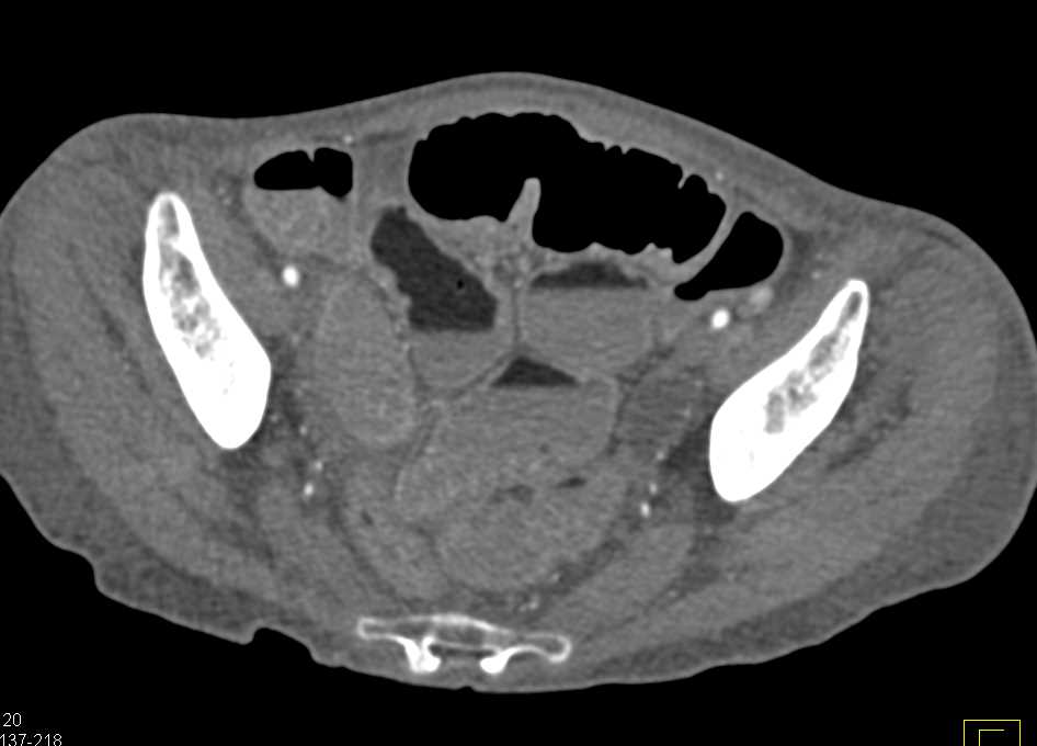 Fat Fluid Level in Bowel in Patient with Malabsorption - CTisus CT Scan