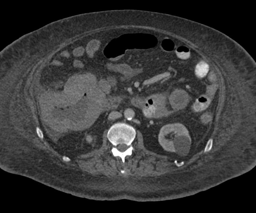 Metastatic Melanoma to the Small Bowel - CTisus CT Scan