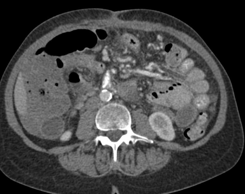 Small Bowel Obstruction due to Adhesions - CTisus CT Scan