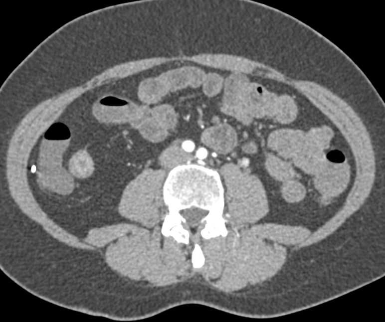 Crohn's Disease Terminal Ileum - CTisus CT Scan