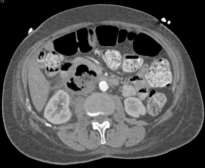 Perforated Duodenal Carcinoma - CTisus CT Scan