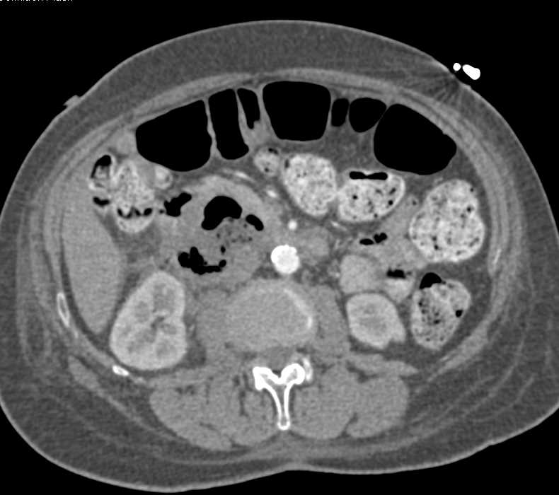 Perforated Duodenal Carcinoma - CTisus CT Scan