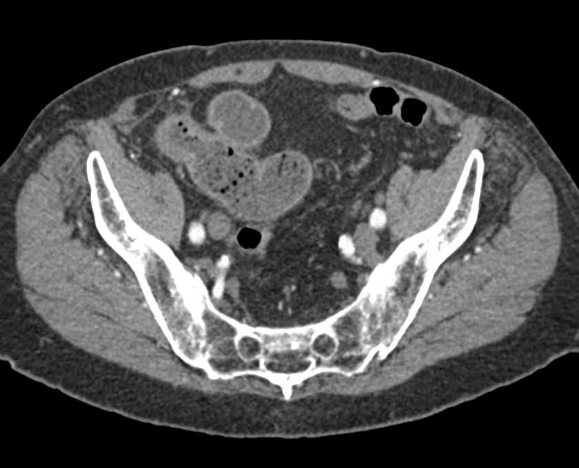 Crohn's Disease Terminal Ileum - CTisus CT Scan