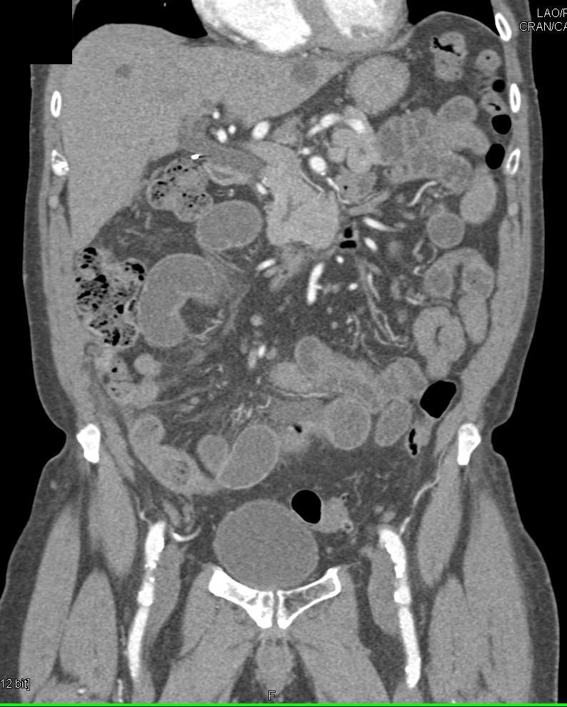 Crohn's Disease Terminal Ileum - CTisus CT Scan