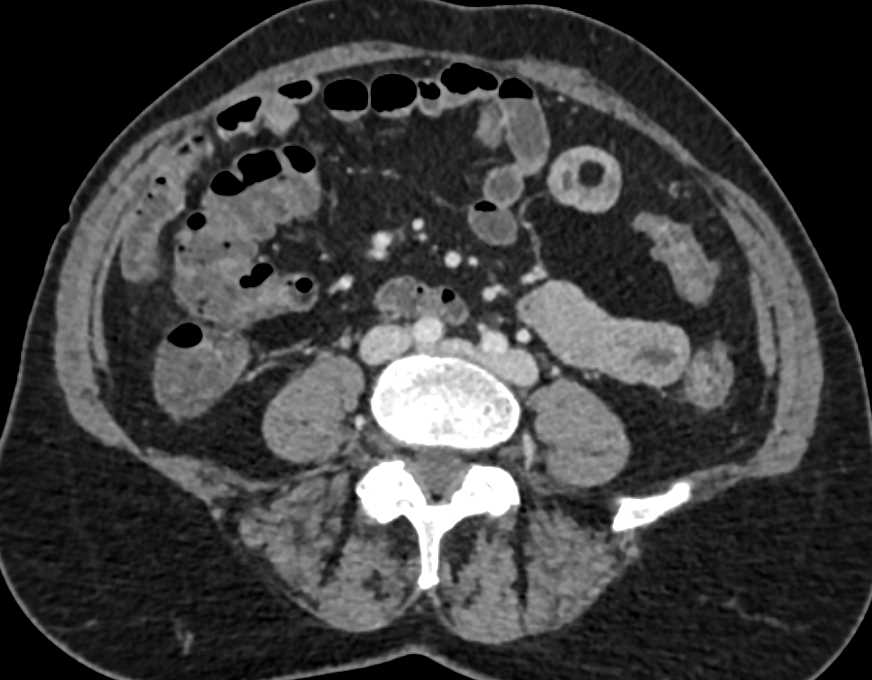 Lipoma in Jejunum - CTisus CT Scan