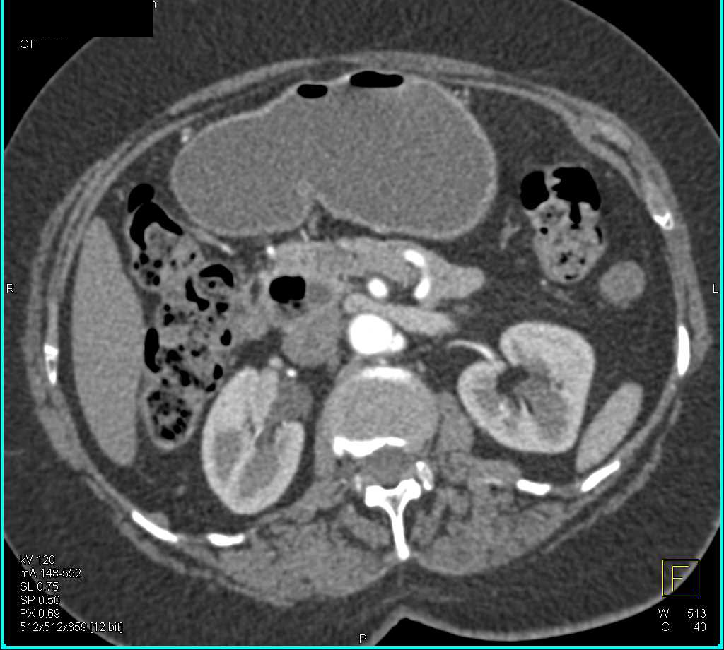 Duodenal Diverticulum Compresses the Common Bile Duct - CTisus CT Scan