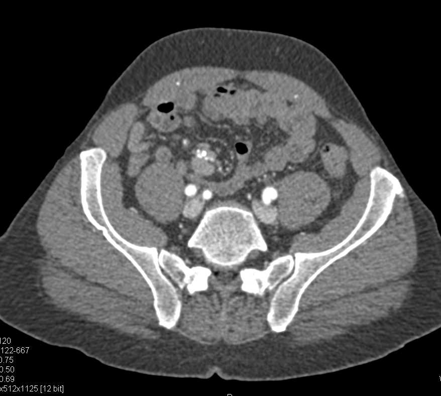 Carcinoid Tumor in the Root of the Mesentery - CTisus CT Scan