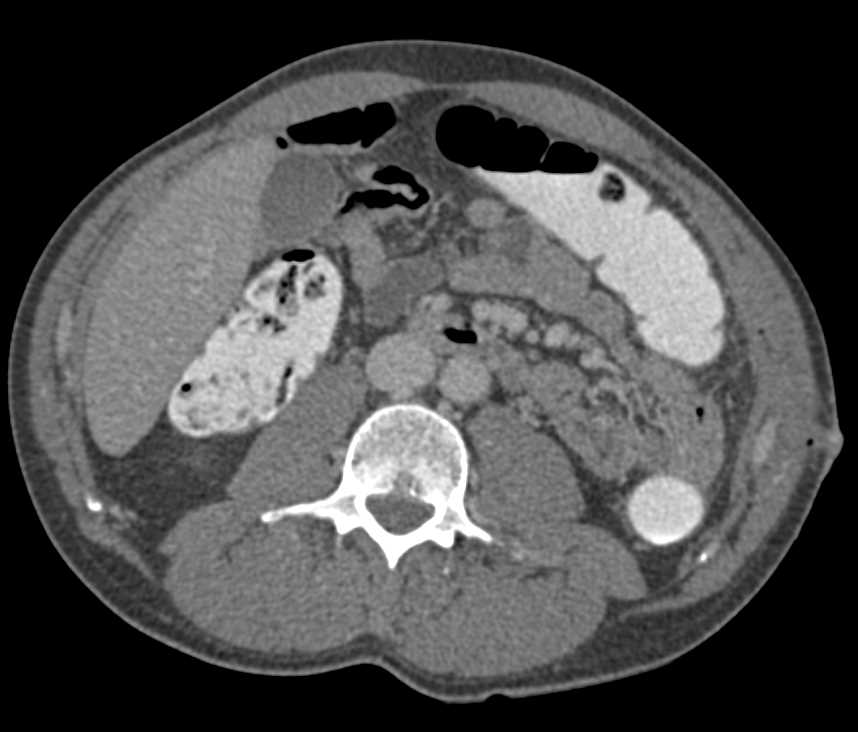 Inflammatory Bowel Disease - CTisus CT Scan