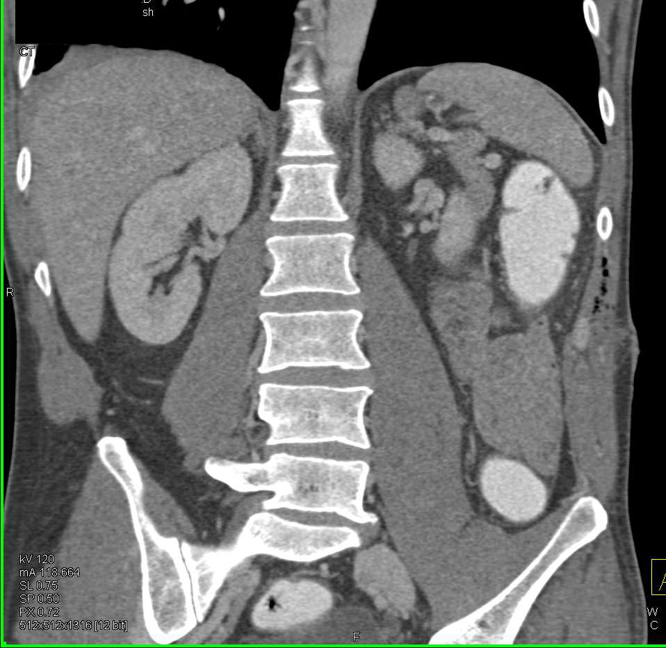 Inflammatory Bowel Disease - CTisus CT Scan