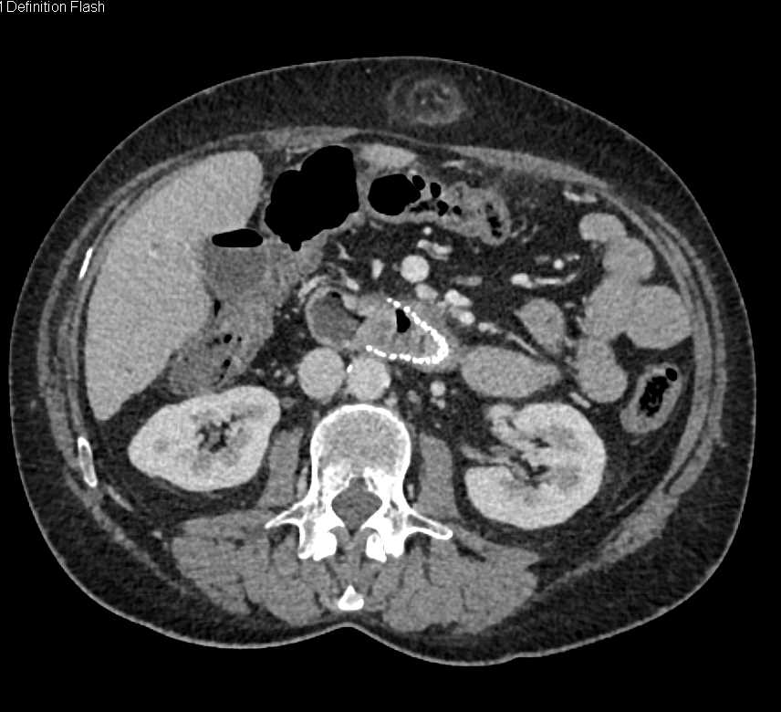 Tumor Infiltration of the Duodenum with Stent in Place - CTisus CT Scan